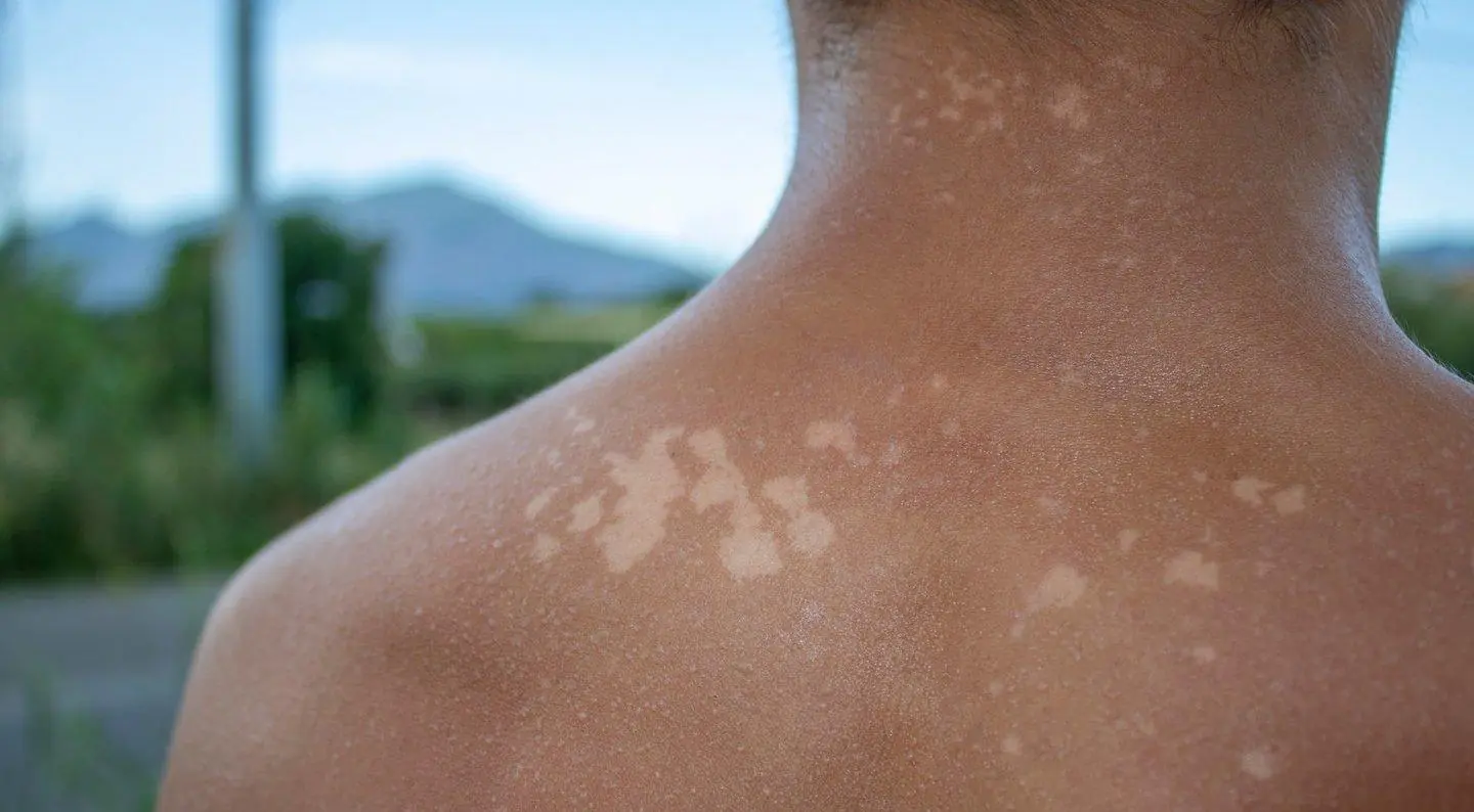 Sun Exposure and Pigment Changes: The Hidden Truth Behind Tiny White Spots on Your Skin