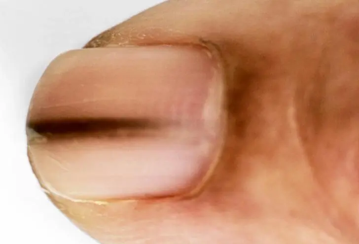 Your Nails May Be Sending Health Signals: Here’s What Those Lines Could Mean