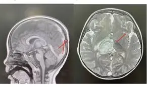 Possible signs of an aneurysm you should never ignore