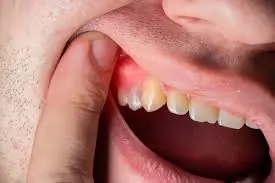 Doctors warn about white bumps appearing in the mouth