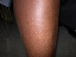 Small white spots on your skin appearing out of nowhere? Here’s what they could mean