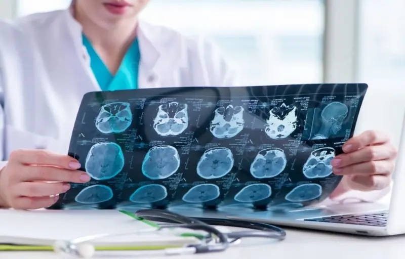 Hemorrhagic Stroke Is Increasing Among Young People — Doctors Say This Is the Leading Cause