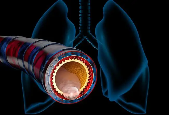 Get Rid of Thick Mucus and Phlegm More Easily With These Tips