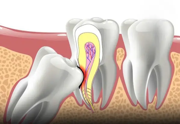 If You Notice These 6 Symptoms, Your Wisdom Tooth May Be Impacted