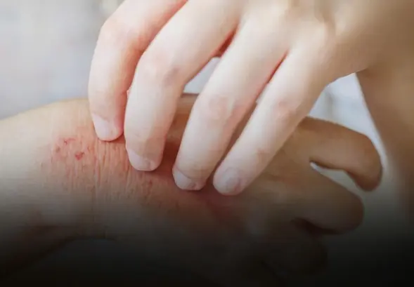 Unexpected Causes of Hives Revealed – What Could Be Triggering Your Skin Reactions?