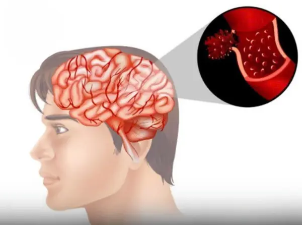 4 Common Morning Habits That Could Increase Your Risk of Stroke