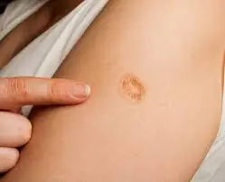 The Real Reason Some People Have a Scar on Their Upper Arm