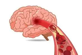 Silent Strokes Are More Common Than Many People Realize — Here’s What May Help Protect Your Brain