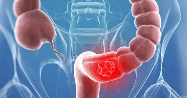 Colon Can.cer May Show These 5 Silent Symptoms Before Diagnosis