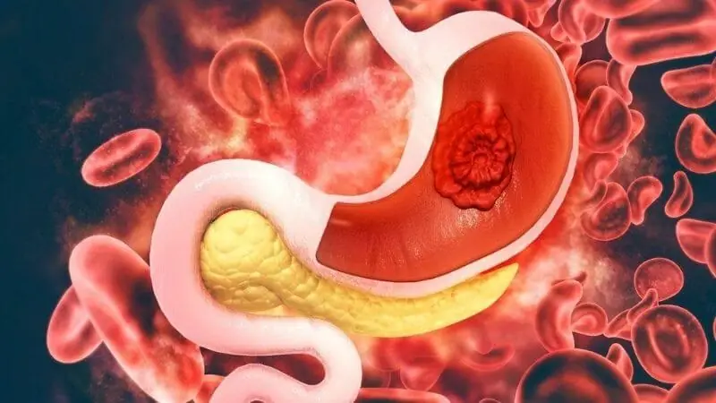 Late-Stage Stomach Can.cer Can Produce These 10 Body Changes