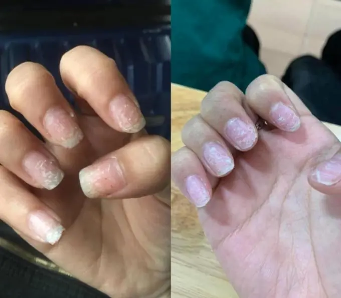 White, Ridged, and Brittle Nails: What Could They Mean?