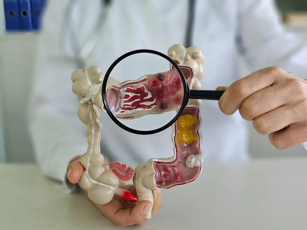 Early Detection Matters: 5 Warning Signs of Colon Cancer You Should Recognize