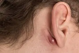 If You Notice a Lump on Your Neck, Back, or Behind Your Ear, Don’t Ignore It
