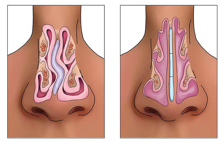 If You Constantly Have Phlegm, There May Be a Reason