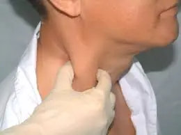 Visible Neck Vein Swelling May Reveal More Than You Think