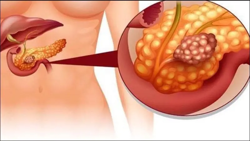 Early Warning Signs of Pancreatic Can.cer You Should Never Ignore