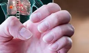 4 Changes in Your Fingers That Could Be Warning Signs of Lung Cancer