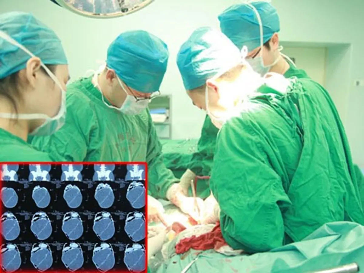 Man’s Belly Swells “Like a Pregnancy” — Doctors Remove a Terrifying 20kg Mass
