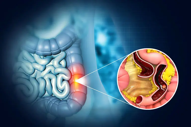After Being Diagnosed With Stage 4 Colon Cancer, She Wants Everyone to Know These 5 Warning Signs