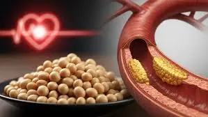 A 12-Month Study Found High-Dose Nattokinase May Help Reduce Arterial Plaque