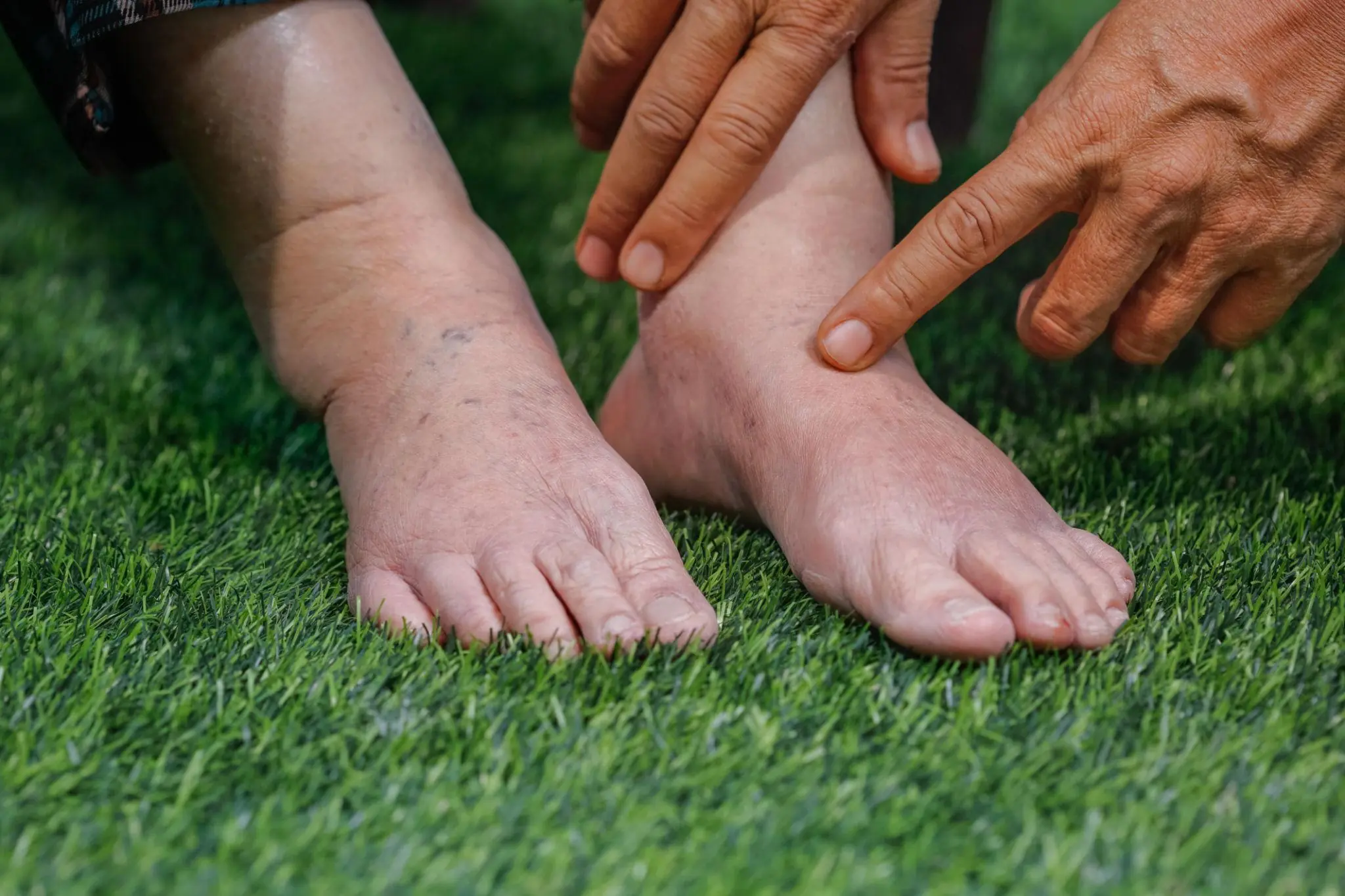 What Your Feet May Be Trying to Tell You About Your Liver?