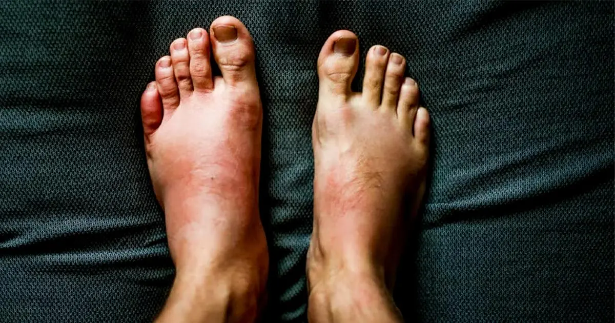 Health Experts Reveal Warning Signs of Two “Silent Foot Kil.lers” You Should Never Ignore