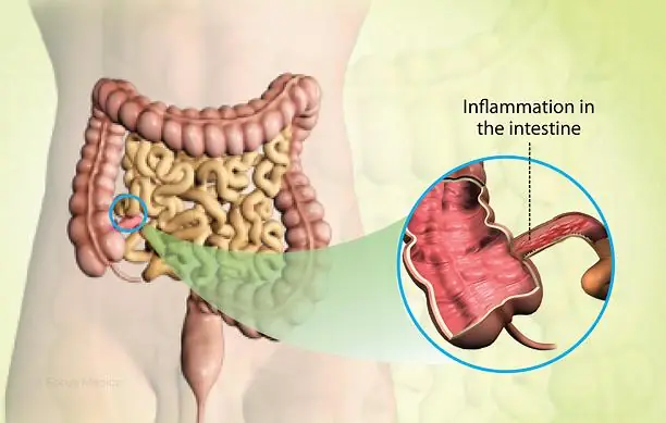 Severe Constipation and To.xic Megacolon: The Dangerous Warning Signs You Should Never Ignore