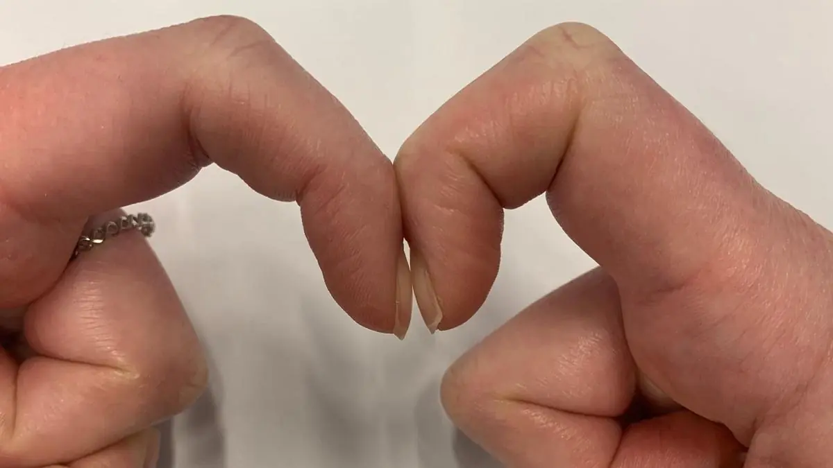 A Simple Finger Test at Home: Can It Really Detect Early Signs of Lung Can.cer?