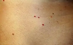 Noticed red dots on your skin? Here’s what they could mean