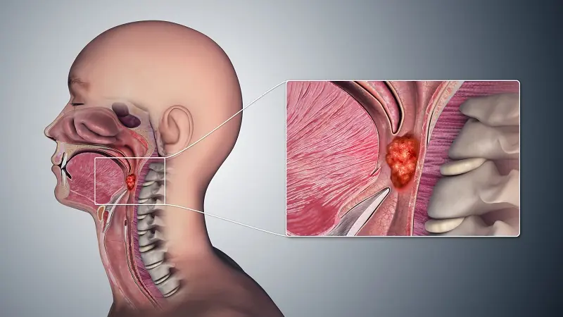 Early Warning Signs of Nasopharyngeal Can.cer Should Never Be Overlooked
