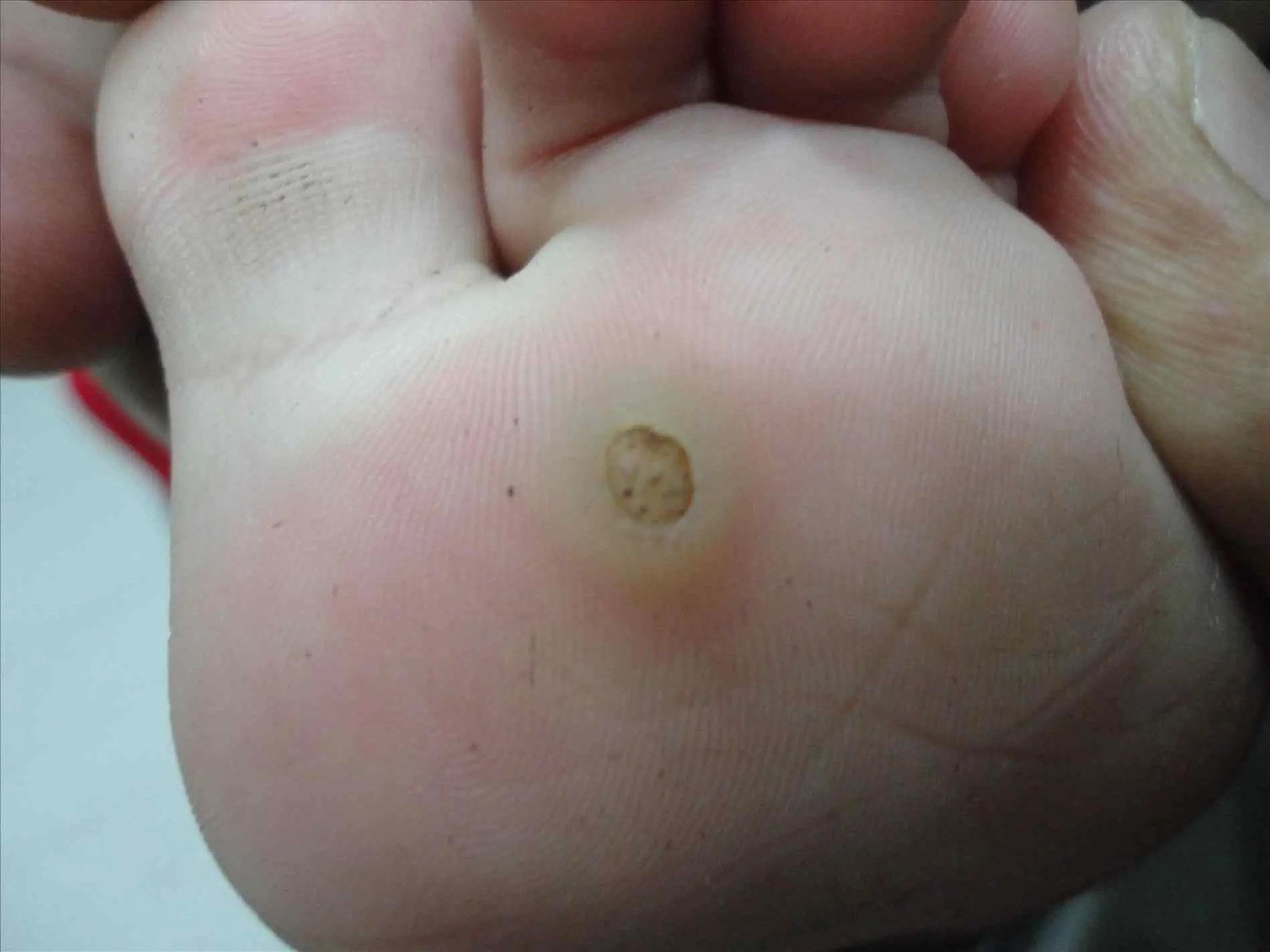 When You Get a “Plantar Callus,” It’s Not Just a Common Corn — Here’s What It Really Is