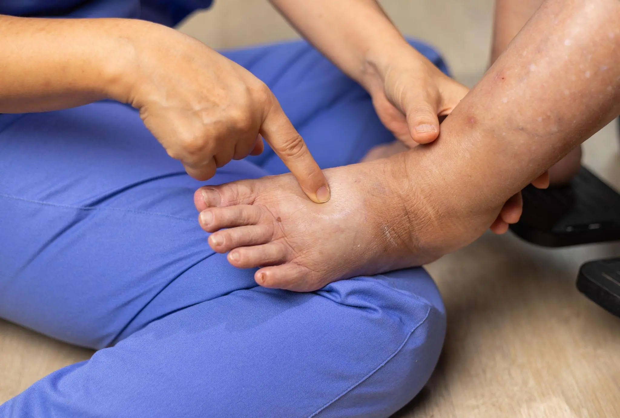 If Your Feet Are Swe.lling Regularly, It Could Signal an Underlying Health Problem