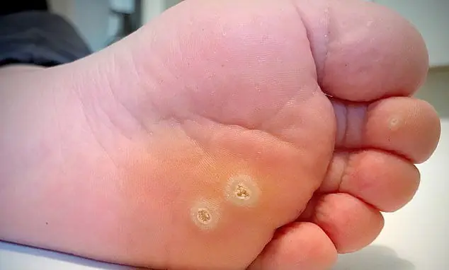 6 Common Types of Warts: Symptoms, Causes, and Treatment Options