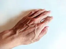 Your visible veins could be telling you something about your body