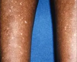 Noticing white spots on your arms or legs? A specialist explains what they could mean