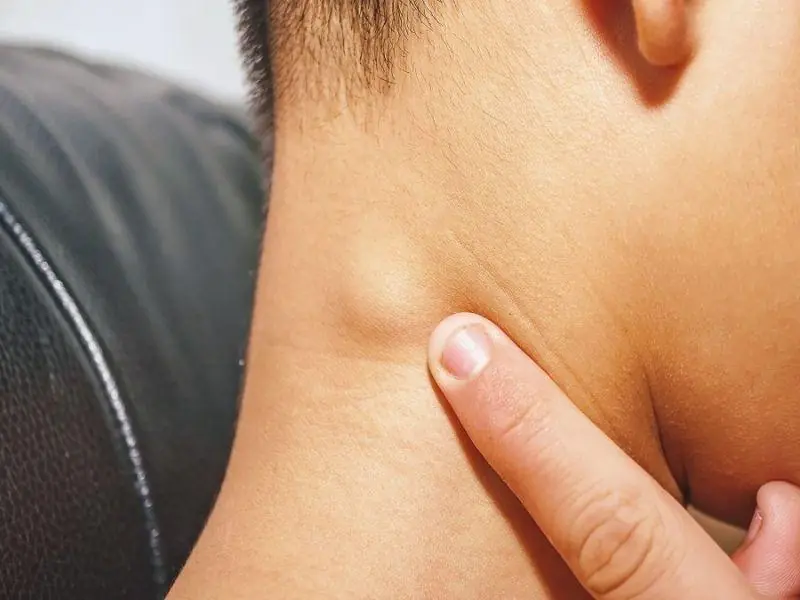 If You Get a Lump on Your Neck, Back, or Behind Your Ear, Here’s What It Could Mean