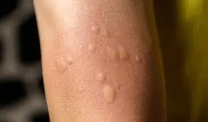 He Had Full-Body Itching and Assumed It Was an Allergy — The Truth Was More Serious