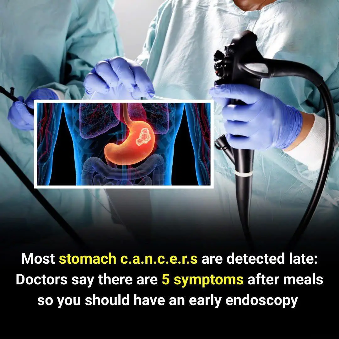 Most Stomach Cancer Cases Are Discovered Too Late — Here’s Why Early Signs Matter
