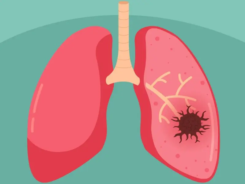 9 Important Lung Can.cer Symptoms to Watch for Early