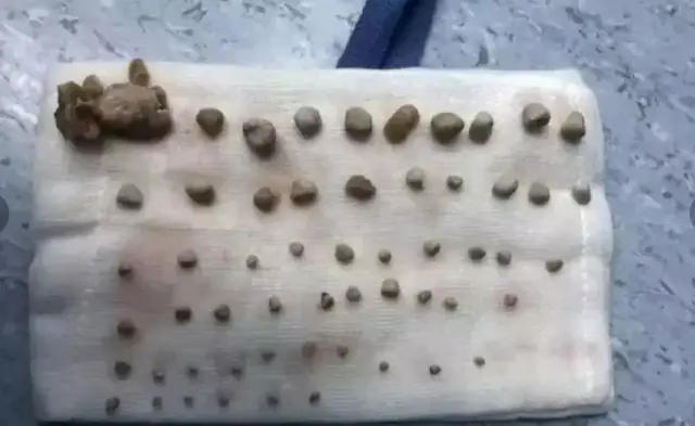 Doctors Remove 56 Kid.ney Stones From 4th Grade Boy — Experts Blame One Dangerous Parenting Habit