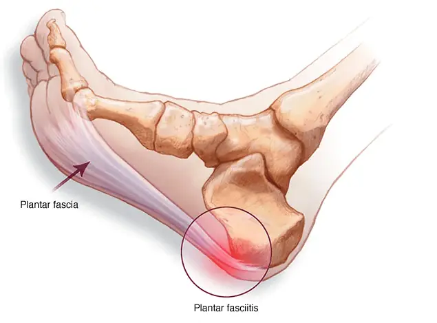 Your heel shouldn’t hurt like this — here’s what it may mean
