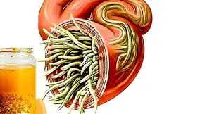7 Popular Foods for Intestinal Worms: Real Treatment or Just a Myth?