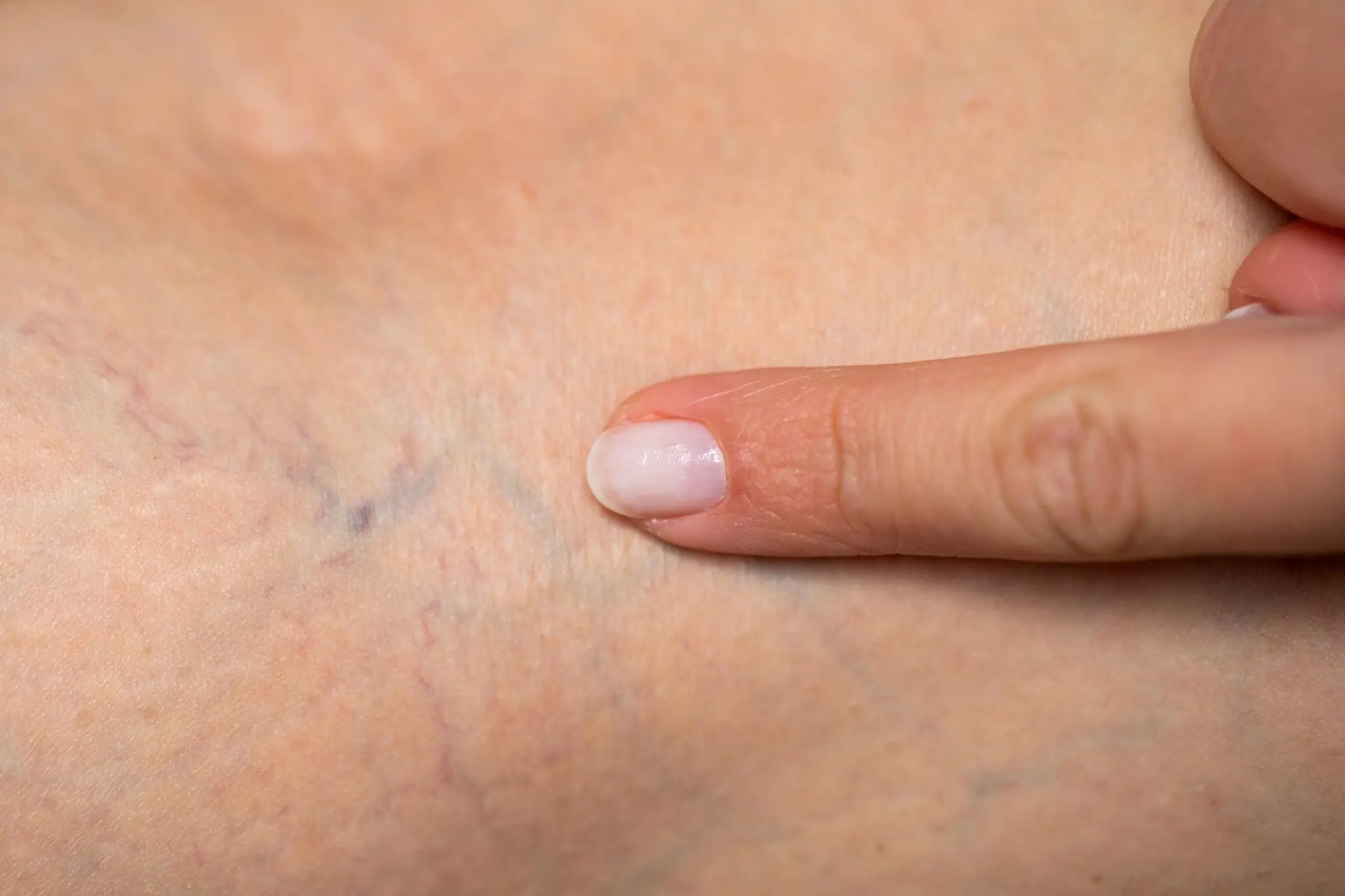 Why Are My Veins Suddenly Bulging and Visible? Here’s What Experts Say
