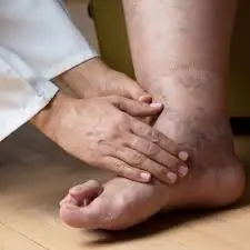 Here’s Why Your Legs Might Be Swelling — And When to Worry 👇