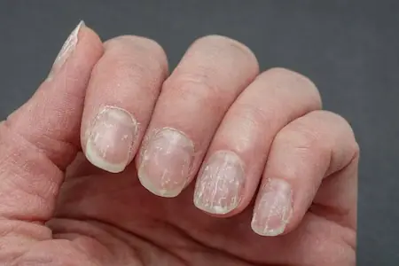 Brittle or ridged nails may signal more than just aging
