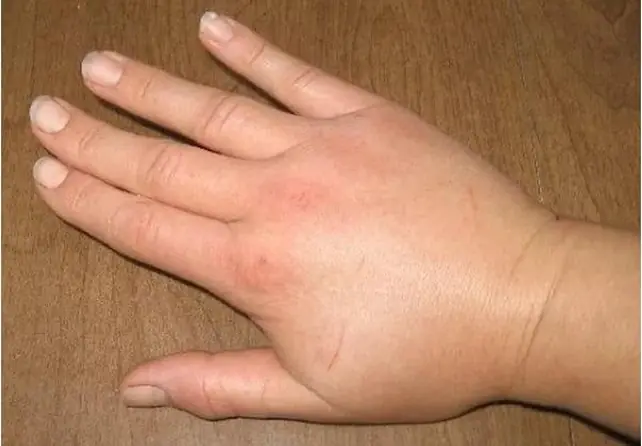 4 Unusual Finger Symptoms That May Be Linked to Lung Can.cer