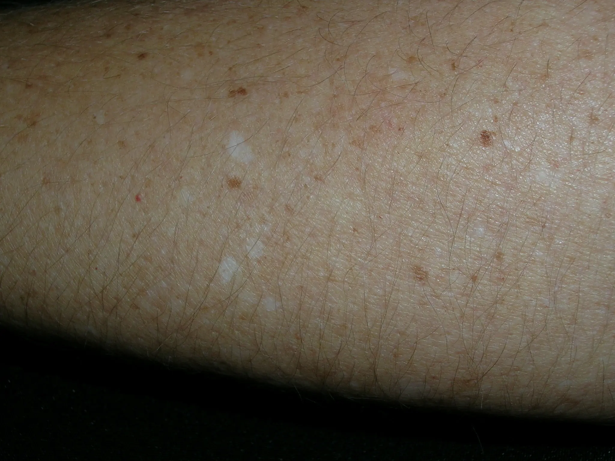 White spots appearing on your arms or legs? Don’t ignore them — here’s what experts say