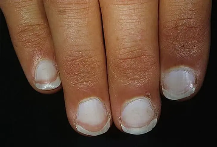 9 warning signs your nails may be sending about your health