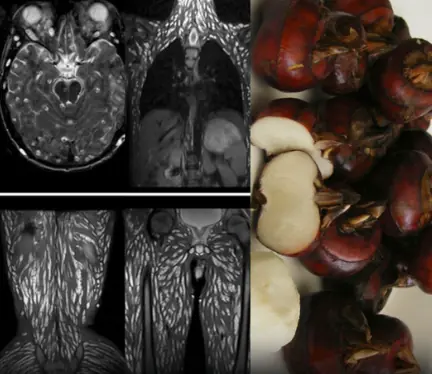 Early Symptoms of Bladder Cancer That Often Go Unnoticed