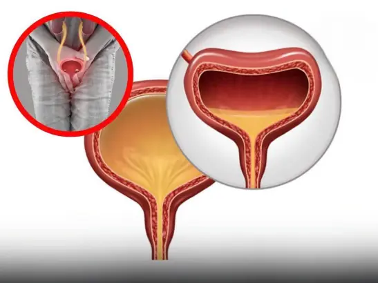 These Early Warning Signs of Bladder Cancer Often Go Unnoticed